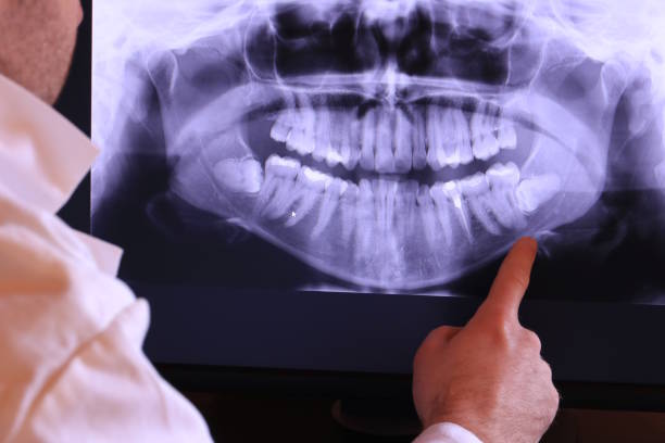 Best Knocked-Out Tooth (Avulsed Tooth) Treatment in Flanders, NY